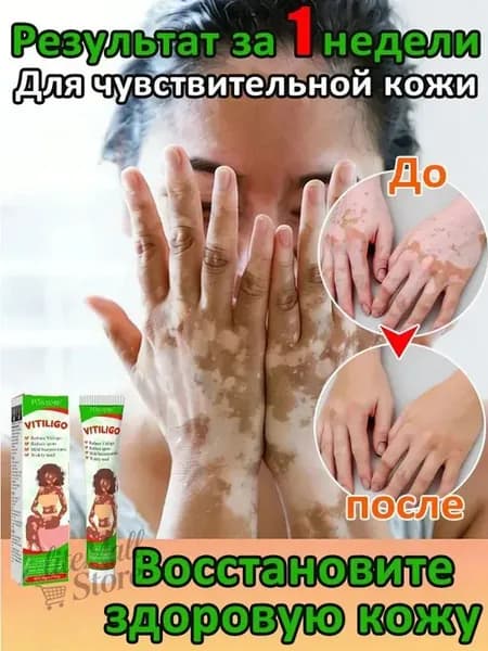 Мазь от витилиго,Средство при нежелательной пигментации витилиго.100 мл