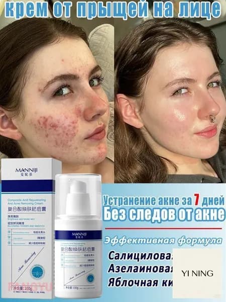 Крем для устранения прыщей 100 г, подходит для лечения акне, воспалений, угрей, следов от прыщей, Салициловая ки