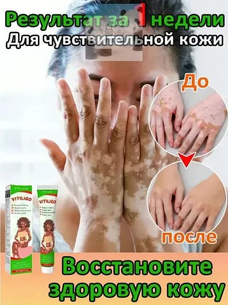 Мазь от витилиго,Средство при нежелательной пигментации витилиго.100 мл