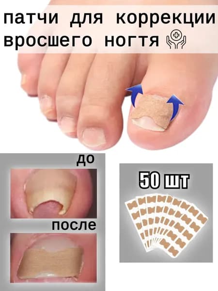 Пластыри для коррекции вросших ногтей на пальцах ног, 50 штук