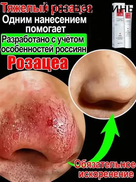 Крем от купероза для лица покраснений на лице и розацеа,Куперофаг Крем от купероза на лице, антикупероз, средство от сосудистых звездочек, от покраснений, розацеа,Китайская чудо-мазь.20 г