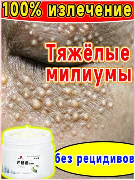 Премиальное средство от милиумов, сыворотка для устранения белых точек и жировиков вокруг глаз, с мягким отшелушиванием без травм, изготовленная из натуральных растительных компонентов