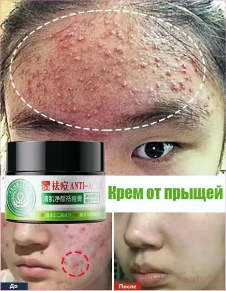 Крем для лица от прыщей на лице с салициловой кислотой и ниацинамидом, эффективное средство от воспалений и угрей, мазь и болтушка от прыщей, 30 г