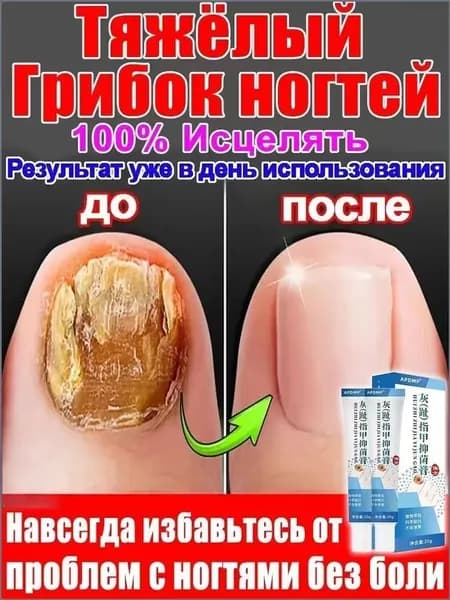 Регенератор Средство от онихолизиса и грибка ногтей