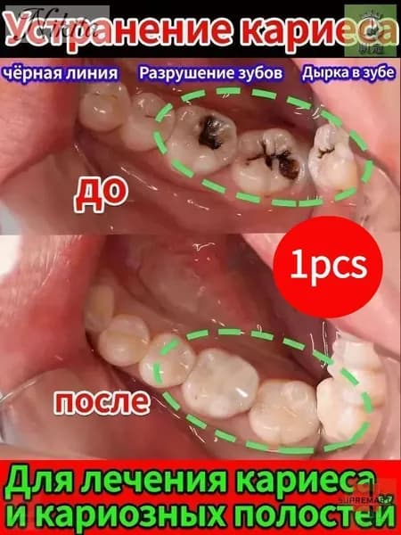 Зубная паста для дырки в зубе, глубокого кариеса и пульпита, Снимает боль, восстанавливает при поражении кариесом у взрослых, Свежее дыхание, 100 г, 1 шт.