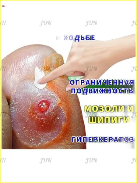 Mазь от мозолей стержневых и натоптышей ,Крем от сухих мозолей, шипицы, бородавок, натоптышей,бородавок без боли, без шрамов.