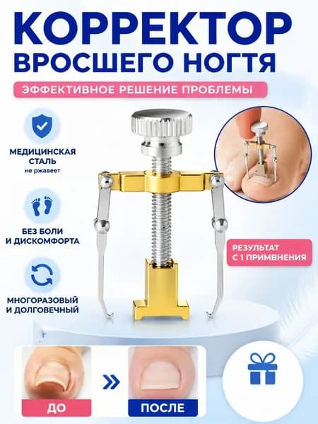 Коррекция вросших ногтей