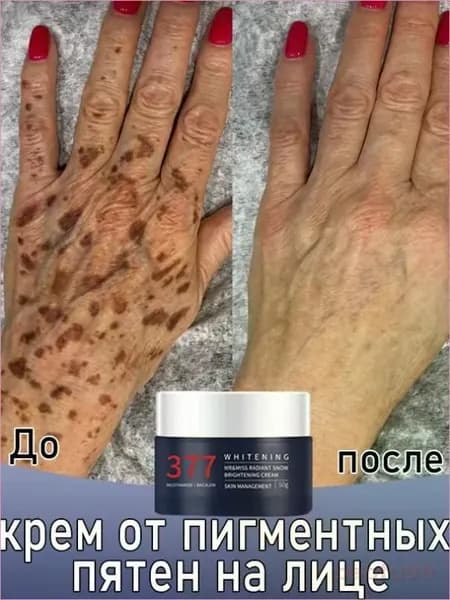 Крем для отбеливания и удаления веснушек, пигментных пятен, мелазмы, для ровного тона кожи и от постакне, 30 мл.