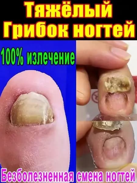 Противогрибковая мазь Ноготок от грибка ногтей на ногах и гиперкератоза, противогрибковое средство для ног,укрепляйте и восстанавливайте ногти