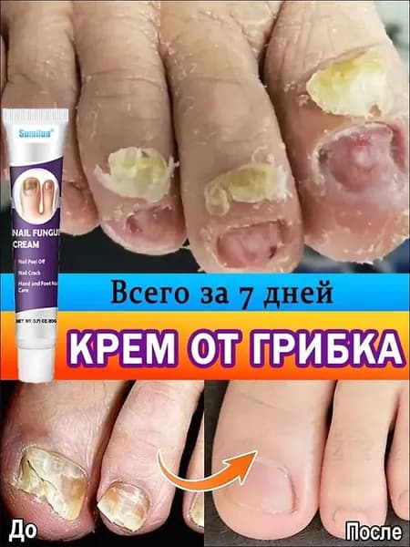 LANBENA Средство от грибка ногтей на ногах. Уход за ногтями, борьба с несовершенствами. Ланбена противогрибковое новое обновленное средство