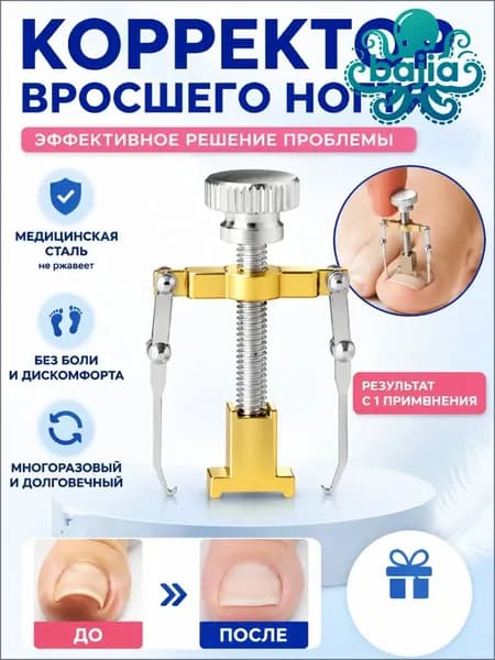 Коррекция вросших ногтей