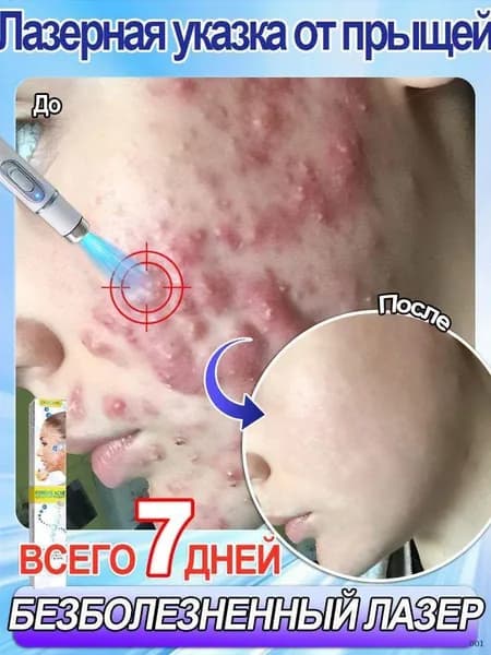 Лазерная указка от прыщей.Удаляйте юношеские и старческие угри, угревые пятна, отметины и ямочки.Лазерное глубокое очищение.Быстро и не раздражает.1 упаковка.