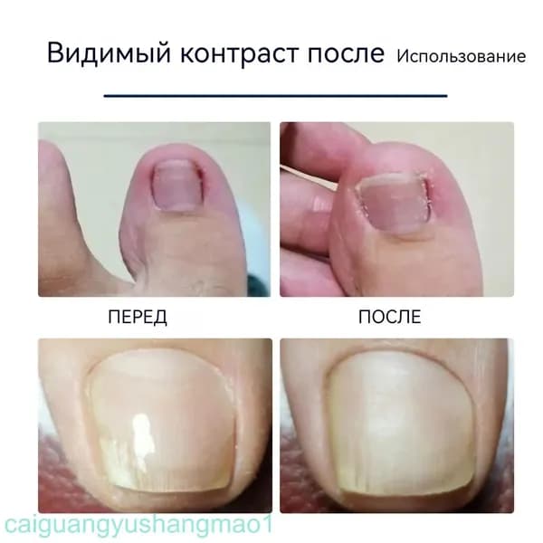 Премиум пластырь излечивает грибок ногтей и кожи