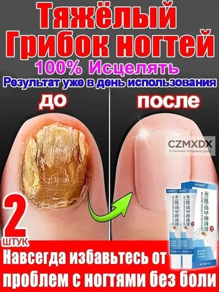 2 штуки,крем ноготок от грибка ногтей на ногах,ноготок мазь от грибка на ногах,гиперкератоз