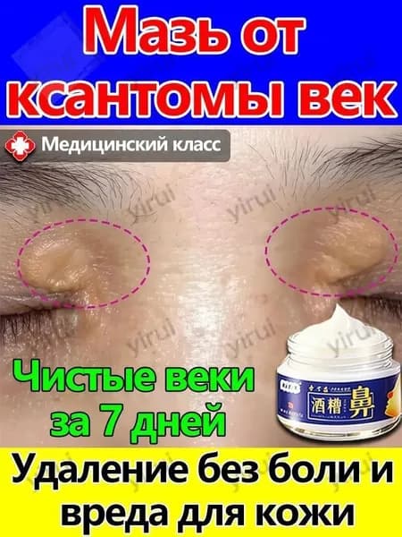Мазь от ксантелазмы и ксантом на веках и лице. Лечение папул и желтых бляшек вокруг глаз. Эффективное средст555