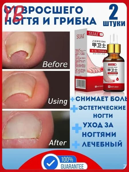 20г Вросшие ногти на ногах,Лазерная указка от онихомикоза избавление от грибка ногтей