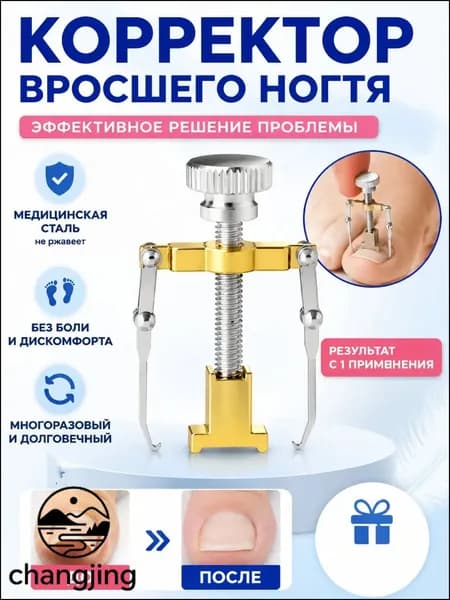 Коррекция вросших ногтей