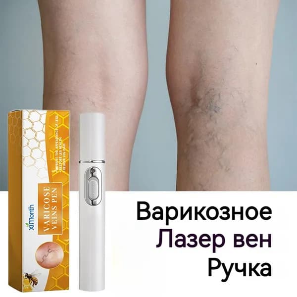 Ручка для лечения варикозного расширения вен,использовать для лечение сосудистых звездочек, тромбоза,отеков и тяжести в ногах,улучшает кровообращение