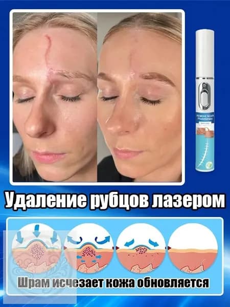 Лазерная ручка для удаления шрамов, используемая для удаления шрамов, растяжек, травм и пигментации, устранения рубцов, восстановления гладкости кожи и быстрого заживления. одна лазерная ручка
