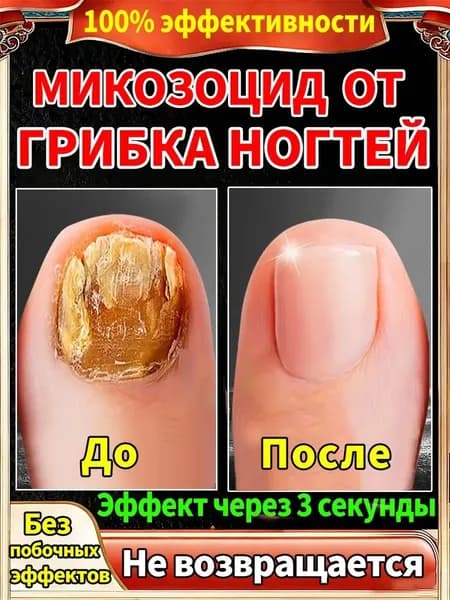 Противогрибковая мазь Ноготок от грибка ногтей на ногах и гиперкератоза, противогрибковое средство для ног,укрепляйте и восстанавливайте ногти, крем для лечения 20g