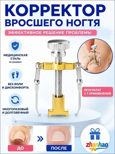 Коррекция вросших ногтей