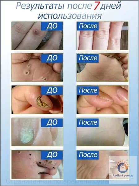 Эксклюзивный курс терапии на 7 дней для безболезненного удаления родинок, бородавок, папиллом и мозолей, 20 г