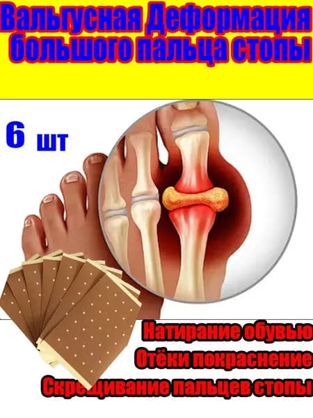 Пластырь от вальгусной деформации большого пальца, косточки на ноге, боли в суставах, деформации пальцев и боли при ходьбе.