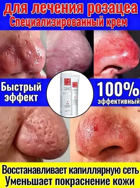 Крем для лица от розацеа, покраснения на лице и Куперофаг купероза против средство сосудистых звездочек, покраснений, китайская чудо-мазь. 20 г.