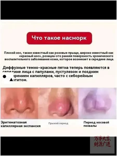крем от розацеаисцеление красный нос и прыщи