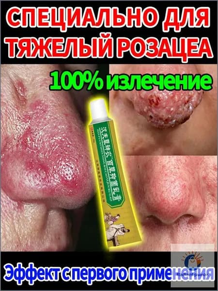 крем от розацеаисцеление красный нос и прыщи