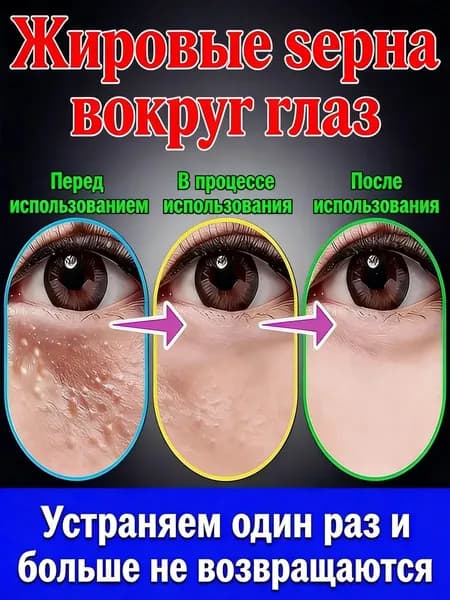 Качественный уходовый крем,Удаление милиумов под глазами и на веках Быстрое избавление от жировых гранул. Мазь/крем для лечения