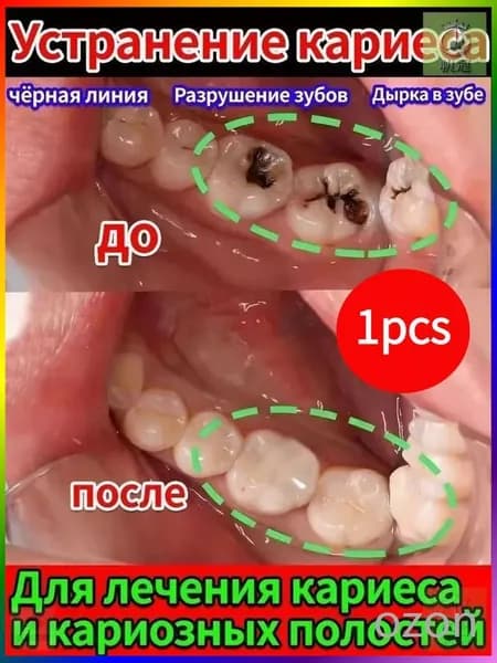 Зубная паста для дырки в зубе, глубокого кариеса и пульпита, Снимает боль, восстанавливает при поражении кариесом у взрослых, Свежее дыхание, 100 г, 1 шт.
