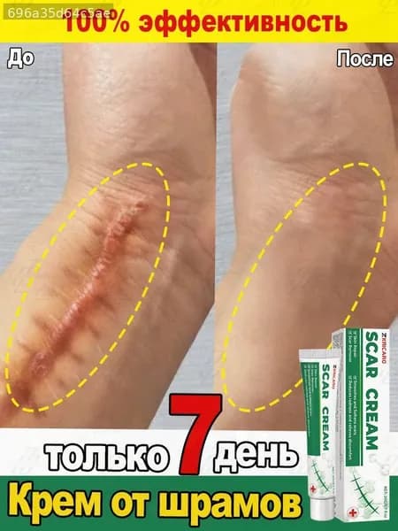 Крем от шрамов и рубцов, гель от прыщей на лице, мазь против ожогов и пигментных пятен и теле, средство от постакне30 г