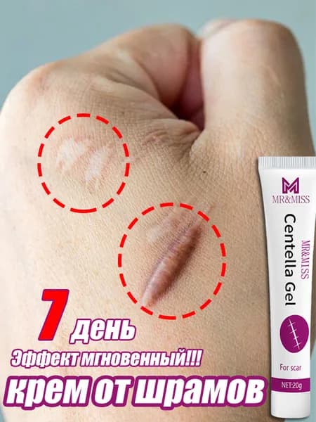 Средство от растяжек