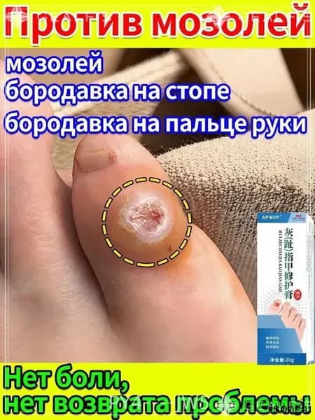 Пластырь и мазь для удаления стержневых мозолей и натоптышей на стопах и пальцах ног. Лечение сухих и болезне