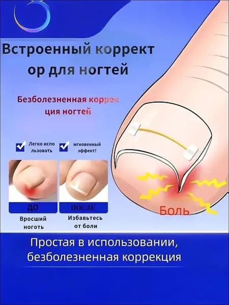 Комплект из 10 никелид-титановых корректоров для вросших ногтей