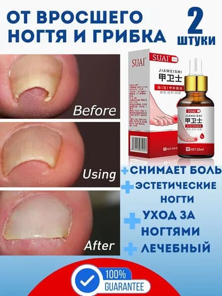 Вросшие ногти на ногах, для ухода за ногтями на ногах