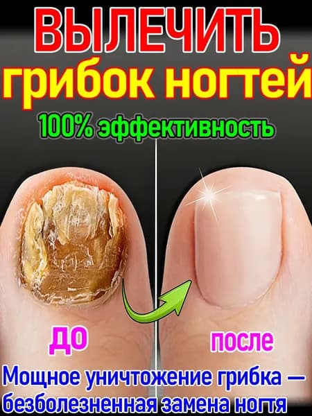 Лак от онихомикоза ногтей, быстрое лечение, не требует спиливания
