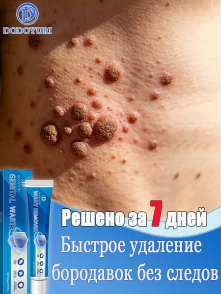 Эксклюзивное средство для удаления папиллом и родинок на лице, руках и ногах, изготовленное на растительном экстракте, массой 20 г, является качественным.