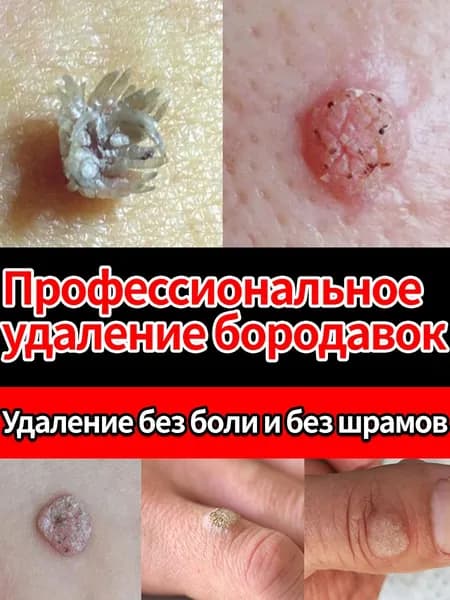 Мазь от нитевидных и плоских бородавок, висячих родинок