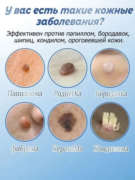 Эксклюзивный препарат для удаления папиллом, родинок и бородавок без шрамов и последствий, 20 г