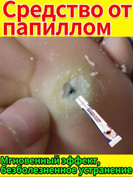 Мазь от шипиц, подошвенных и ладонно-подошвенных бородавок, натоптышей и мозолей на ногах - эффективное удаление и лечение для женщин и мужчин