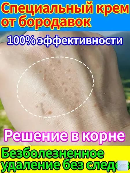 Безболезненное удаление плоских бородавок, папиллом, нитевидных и остроконечных кондилом без шрамов