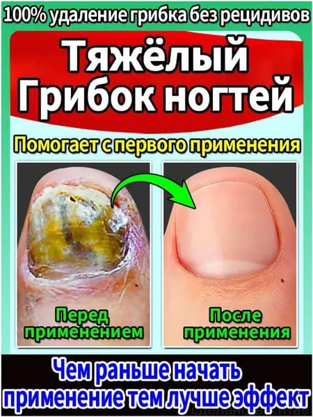 Антибактериальный лак для ногтей. Устраняет грибковые инфекции ногтей на руках и ногах. Эффективно устраняет трещины и отеки, вызванные паронихией. Снимает зуд и восстанавливает ногти.30мл