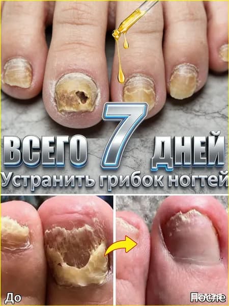 Гель Ноготок от грибка ногтей противогрибковый крем для ног, устраняет зуд, утолщение и трещины, восстанавливает повреждённые ногти, эффективен при гиперкератозе