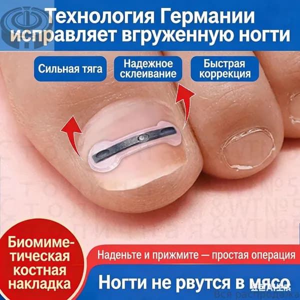 Набор для коррекции вросшего ногтя из никель-титанового сплава для домашнего лечения