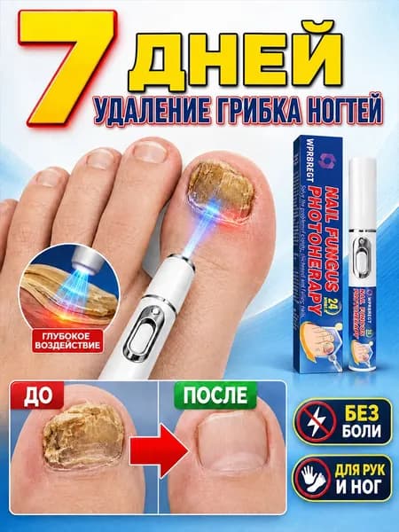 Лазерная ручка от грибка ногтей, быстро устраняет онихомикоз синим светом, убирает желтизну, утолщение, ломкость, зуд и трещины, помогает при паронихии, восстанавливает ногти рук и ног без боли, 2 шт.