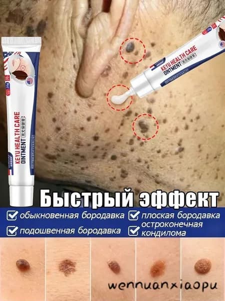 Китайская Чудл Мазь средство от папиллом и бородавок , гель от прыщей. Крем для тела, рук, ног. Антипапиллом