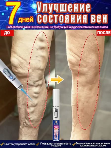 Лазерная ручка для лечения варикозного расширения вен. Эффективно устраняет варикозное расширение вен, сосудистые проблемы, сосудистые звездочки, тромбоз, отёки ног и тяжесть.Упаковка из 1 штук.