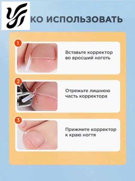 Корректор От Вросших Ногтей На Ногах